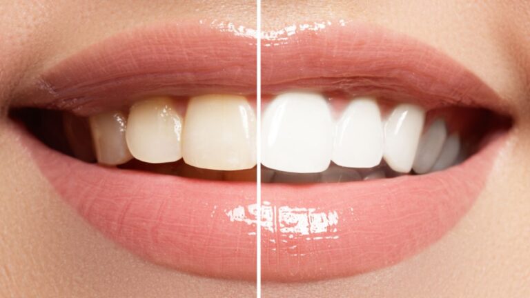 Veja as diferenças entre o clareamento dental antes e depois