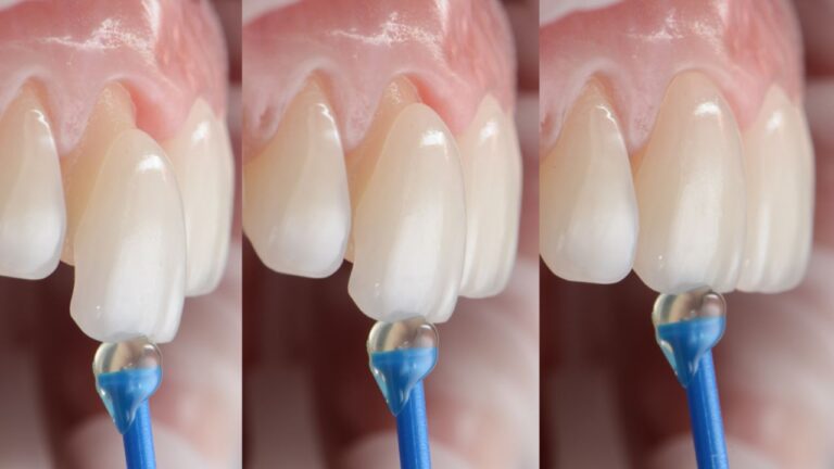 Coloquei lentes de contato dental e me arrependi. E agora?