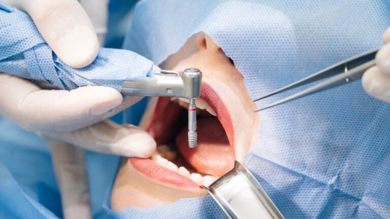 Você sabe como é feito o implante dentário? Confira aqui!