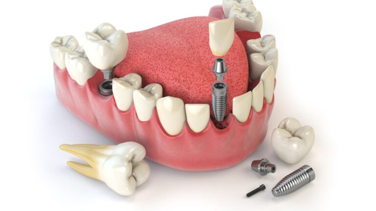 Implante dentário dói? Conheça os cuidados que se deve ter!