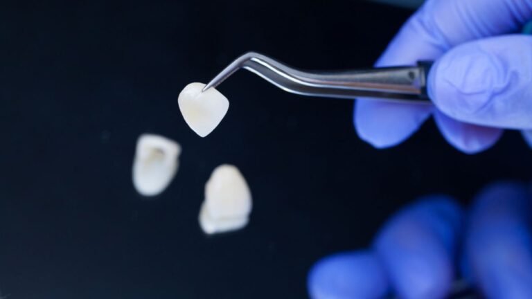 Como funciona as lentes de contato dental? Saiba mais aqui