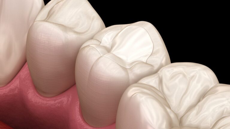 Dente com resina: o que é, como colocar e como cuidar