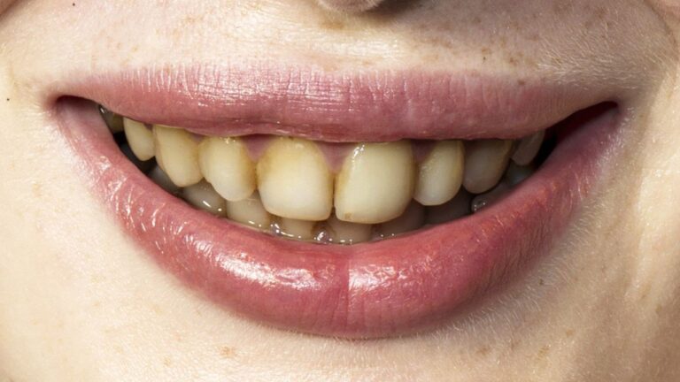 Saiba o que pode deixar o dente escuro e como clareá-lo