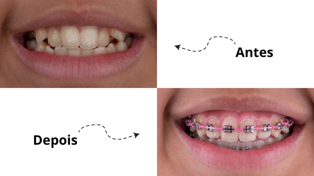 Veja quais as diferenças dos dentes tortos antes e depois! Veja quais as diferenças dos dentes tortos antes e depois!
