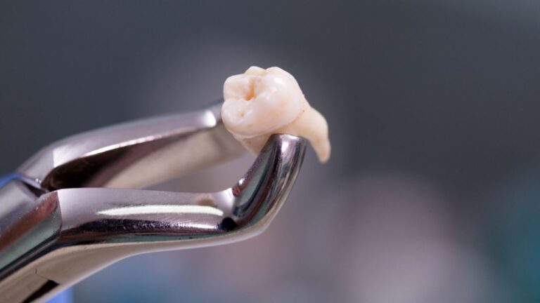 Confira como é feito o procedimento de extrair dente siso