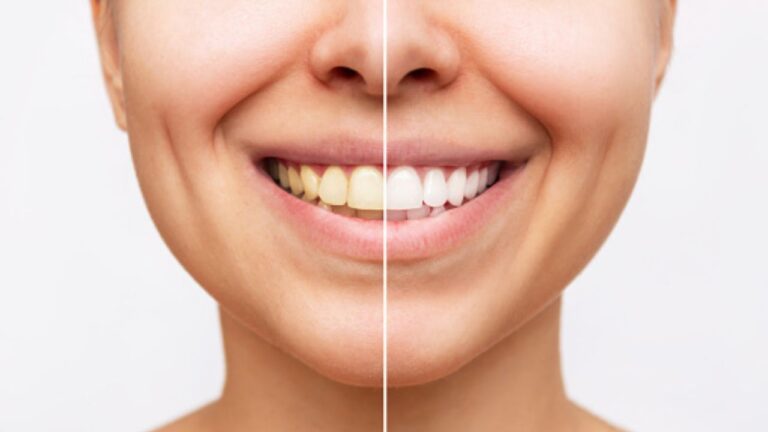 Limpeza de dente antes e depois: descubra os resultados