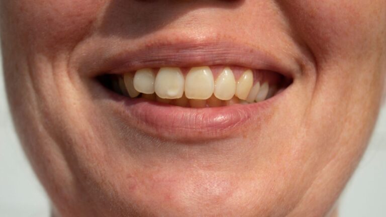 Confira as principais causas das manchas nos dentes