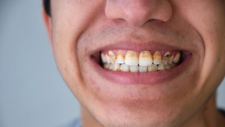 Dente com tártaro: o que causa, como tirar e complicações