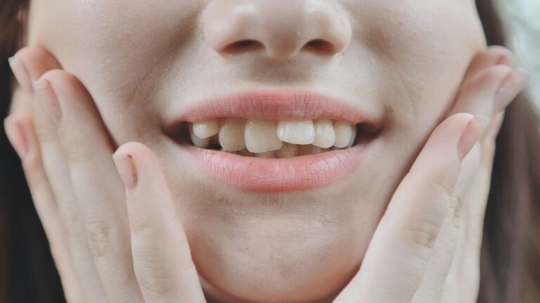 Dente encavalado: conheça as principais causas e como tratar