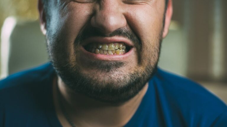 Dente escurecido: veja as principais causas e como clarear