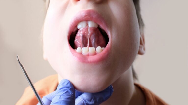 Frenectomia: o que é, como é feita e por que é feita