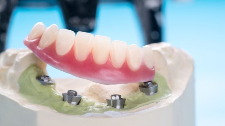 Protocolo dentário: conheça mais sobre ela e suas vantagens!