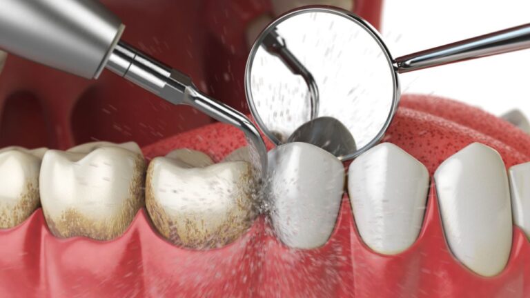 Raspagem dental: o que é, para que é feita e benefícios