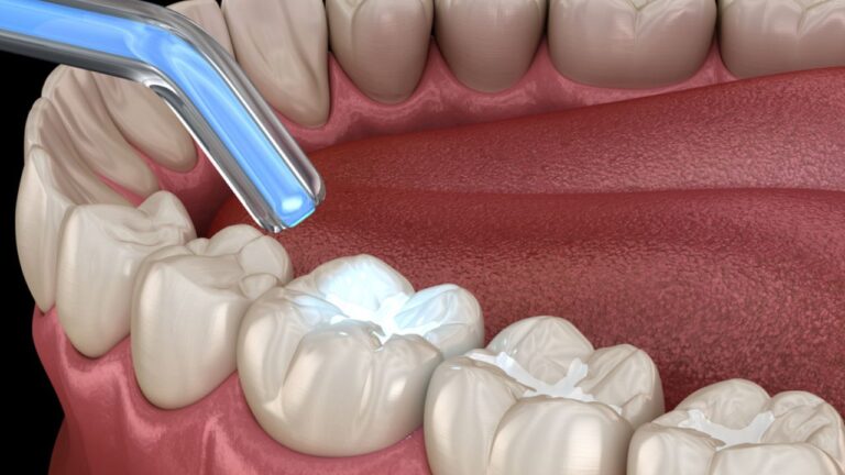 Resina nos dentes: confira seus principais usos e cuidados!