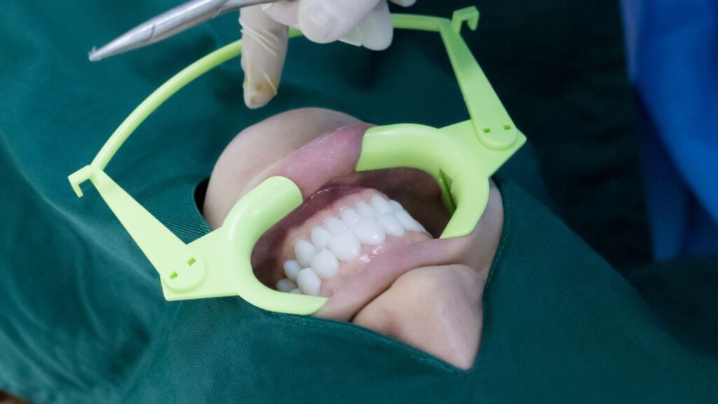 Quanto custa facetas de resina? Confira mais sobre e seu valor