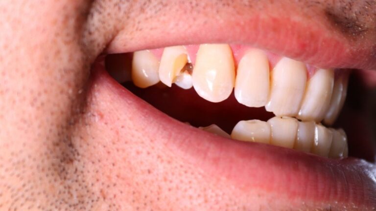 Dente aberto: confira as causas e o que fazer nessa situação