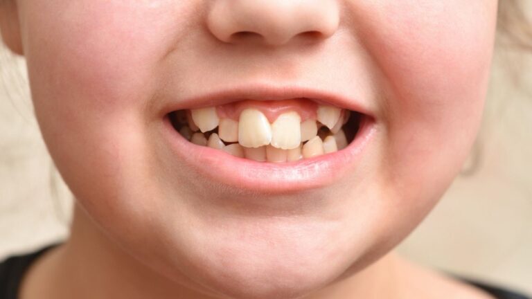 Dente entramelado: o que é, o que causa e como tratar