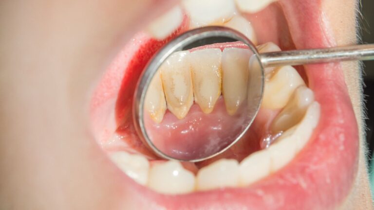 Placa bacteriana: o que é, o que causa e como remover