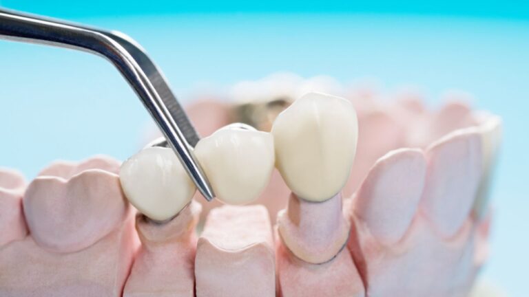 Ponte fixa: conheça mais sobre esse modelo de prótese