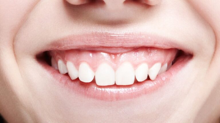 Sorriso gengival: o que é, o que causa e como corrigir