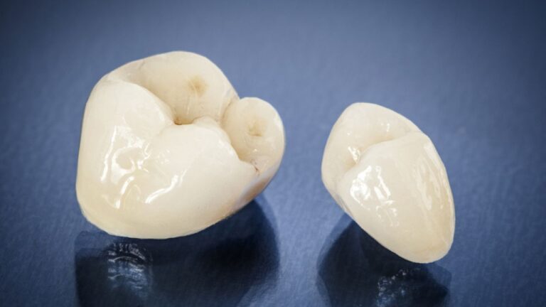 Coroa dentária: o que é, para que serve, tipos e cuidados