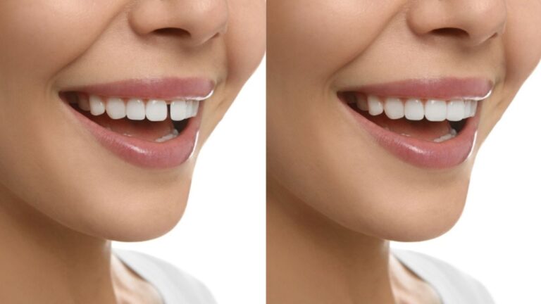 Diastema antes e depois: veja as diferenças após corrigi-lo