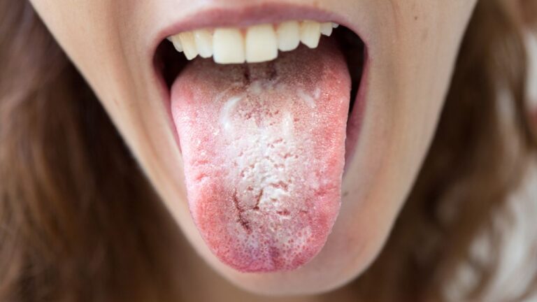 Sintomas de candidíase oral: confira quais são os principais