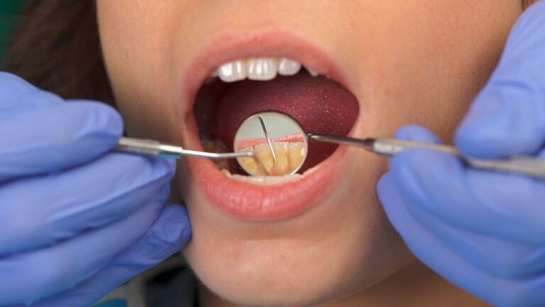 Tártaro: o que é, o que causa e como removê-lo dos dentes