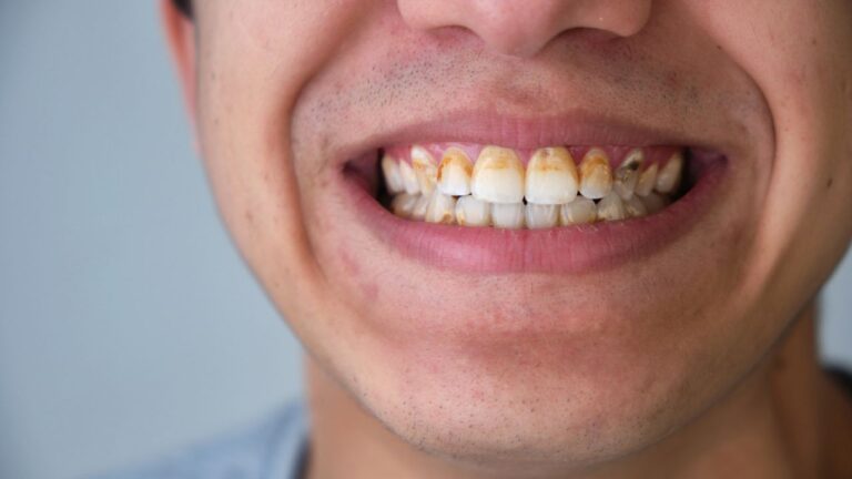 Tártaro no dente: confira o que é e como remover dos dentes