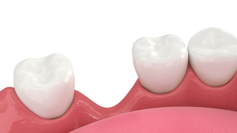 Perda óssea dentária: o que é, causa, tratamento e prevenção