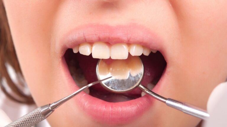 Placa dental: o que é, o que causa e como removê-la