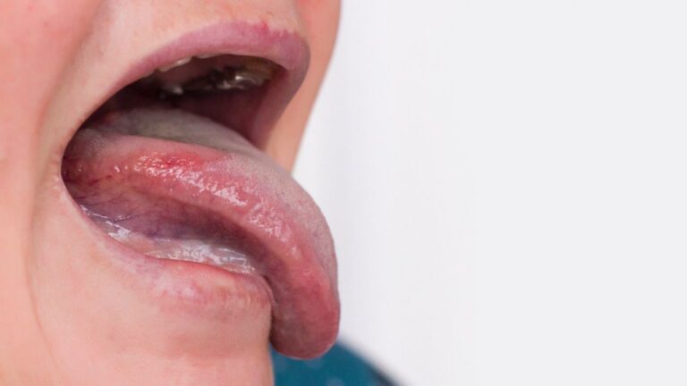 Leucoplasia causas: veja o que é e o motivo de ela surgir!