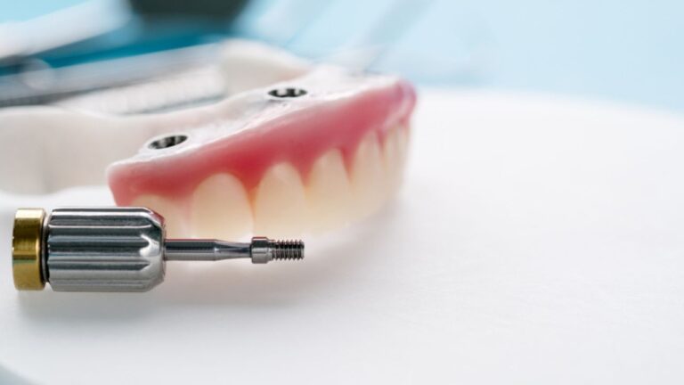Overdenture superior: o que é e como é feita sua fixação!