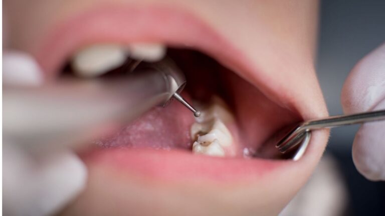 Obturação de dente: saiba de tudo o que você precisa!