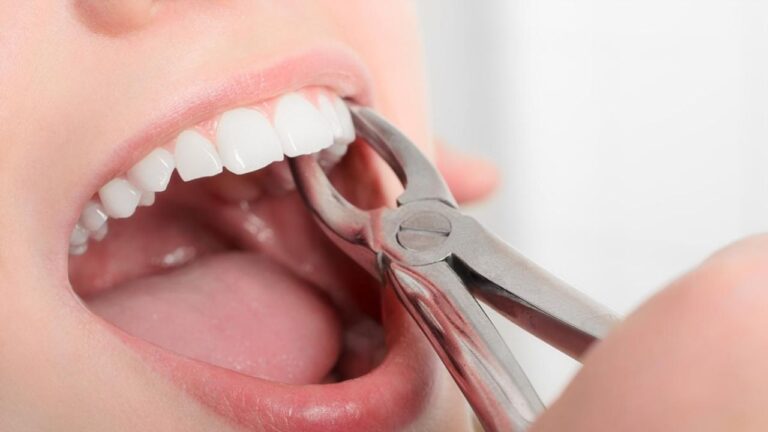 Exodontia: confira o que é, por que é feita e como é feita!