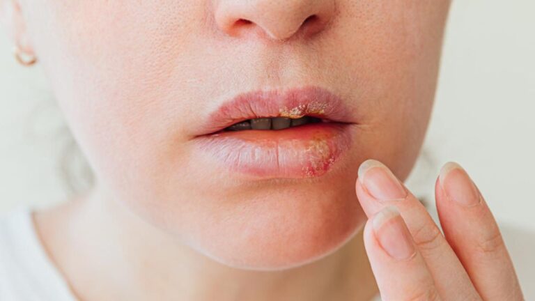 Herpes labial: o que é, o que causa e como tratá-la!