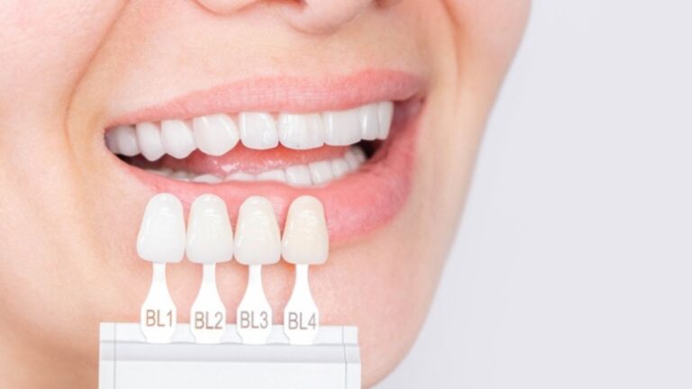 Facetas de porcelana: conheça mais sobre o procedimento