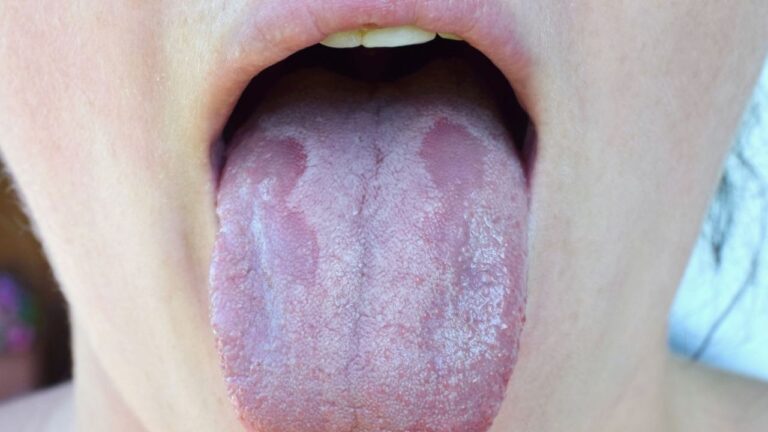 Leucoplasia pilosa: conheça seus sintomas, causas e tratamento