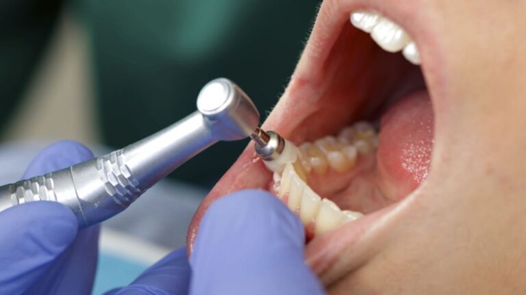 O que é profilaxia dental? Saiba tudo sobre o procedimento