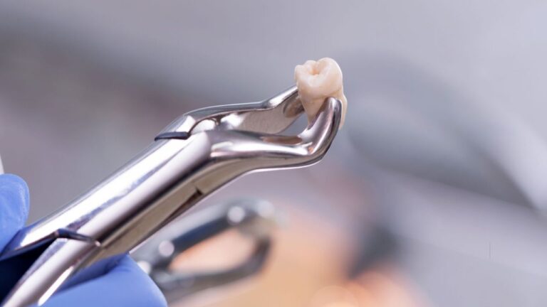 Dente siso inflamado: saiba como identificar e tratar o problema