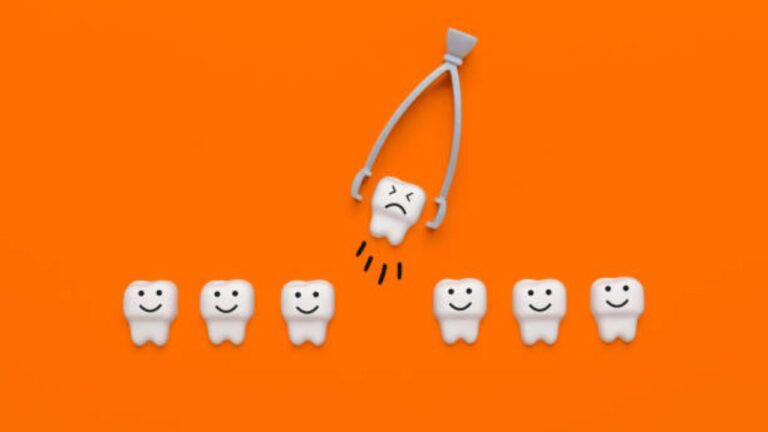 Extração de dente: saiba quando fazer e como funciona!