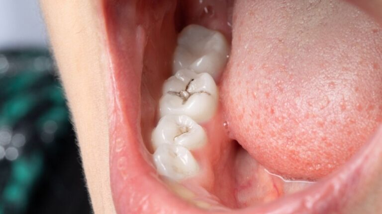 Dente com cárie: confira como surge e como tratá-lo!