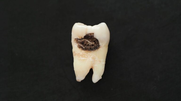 Dente podre: saiba como identificar e tratar o problema
