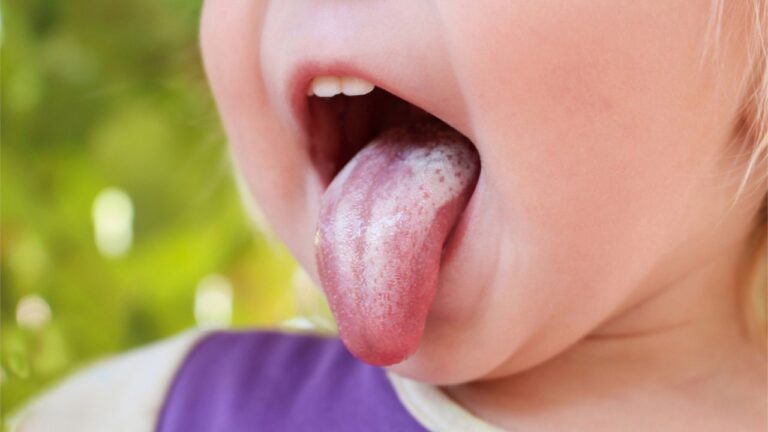 Sapinho em bebê: confira mais sobre esta condição!