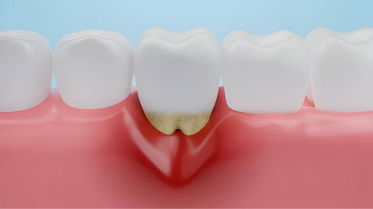 Está com dente inflamado? Saiba como tratar e aliviar a dor!