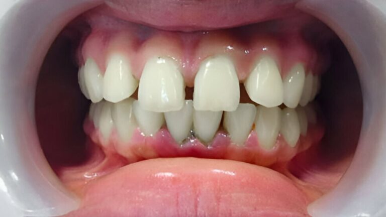 O que é diastema? Tire suas dúvidas sobre tratamentos e causas!