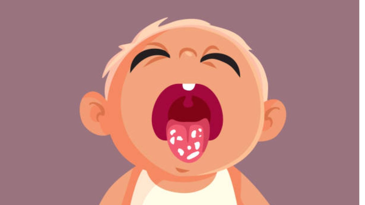 Sapinho Em Bebês: Sintomas, Causas E Tratamento – EXFNKL