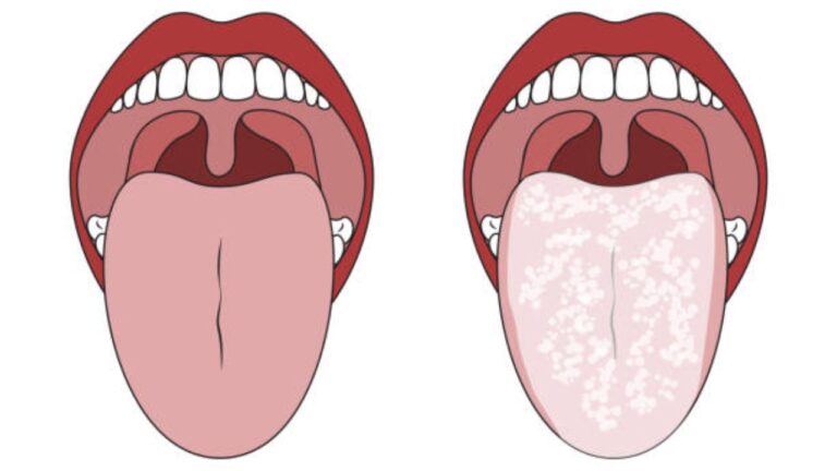 Sapinho na lingua: o que é, causas, prevenção e como tratar!