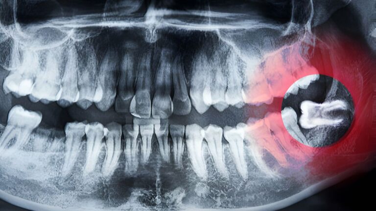 Siso nascendo? Veja aqui, dúvidas e dicas sobre o dente!