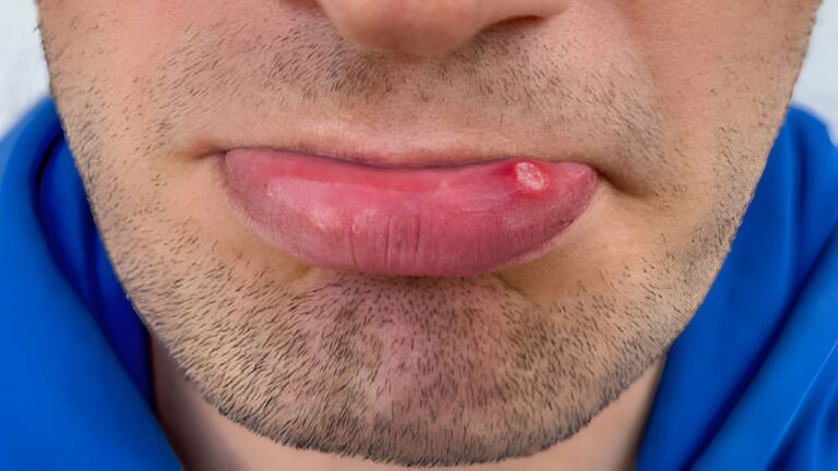 Bolinha na boca? Saiba o que pode ser e veja os tratamentos!